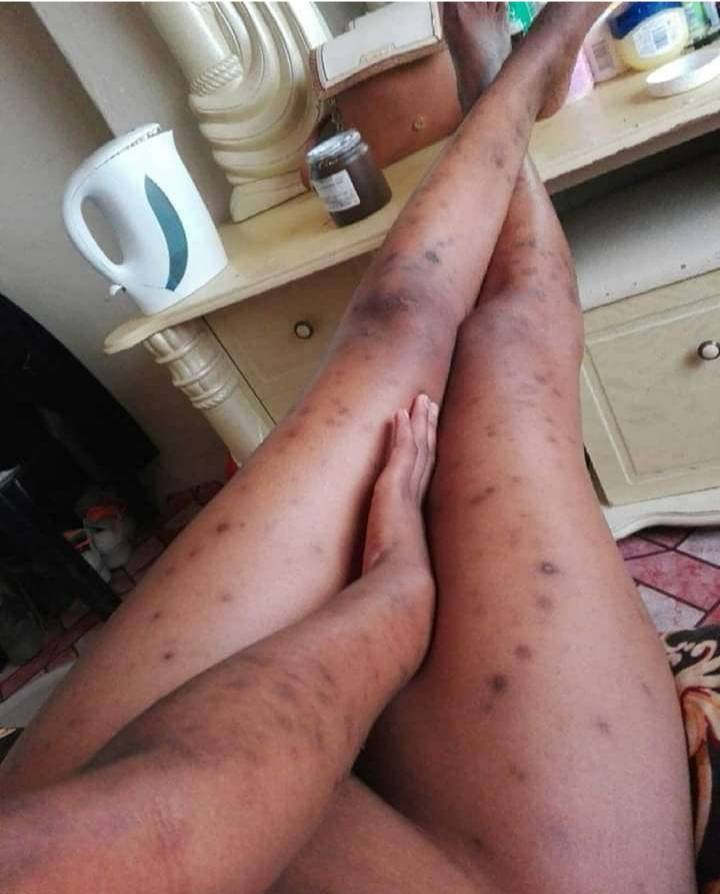 Hyperpigmentation and dark spots on legs and thighs — a common skin concern for African women